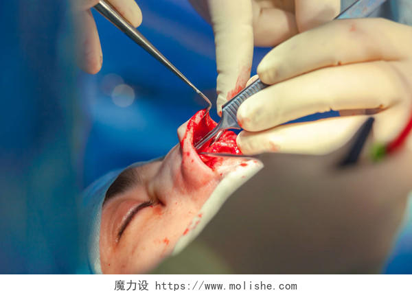 外科医生和他的助手执行整容手术在医院手术室的鼻子上